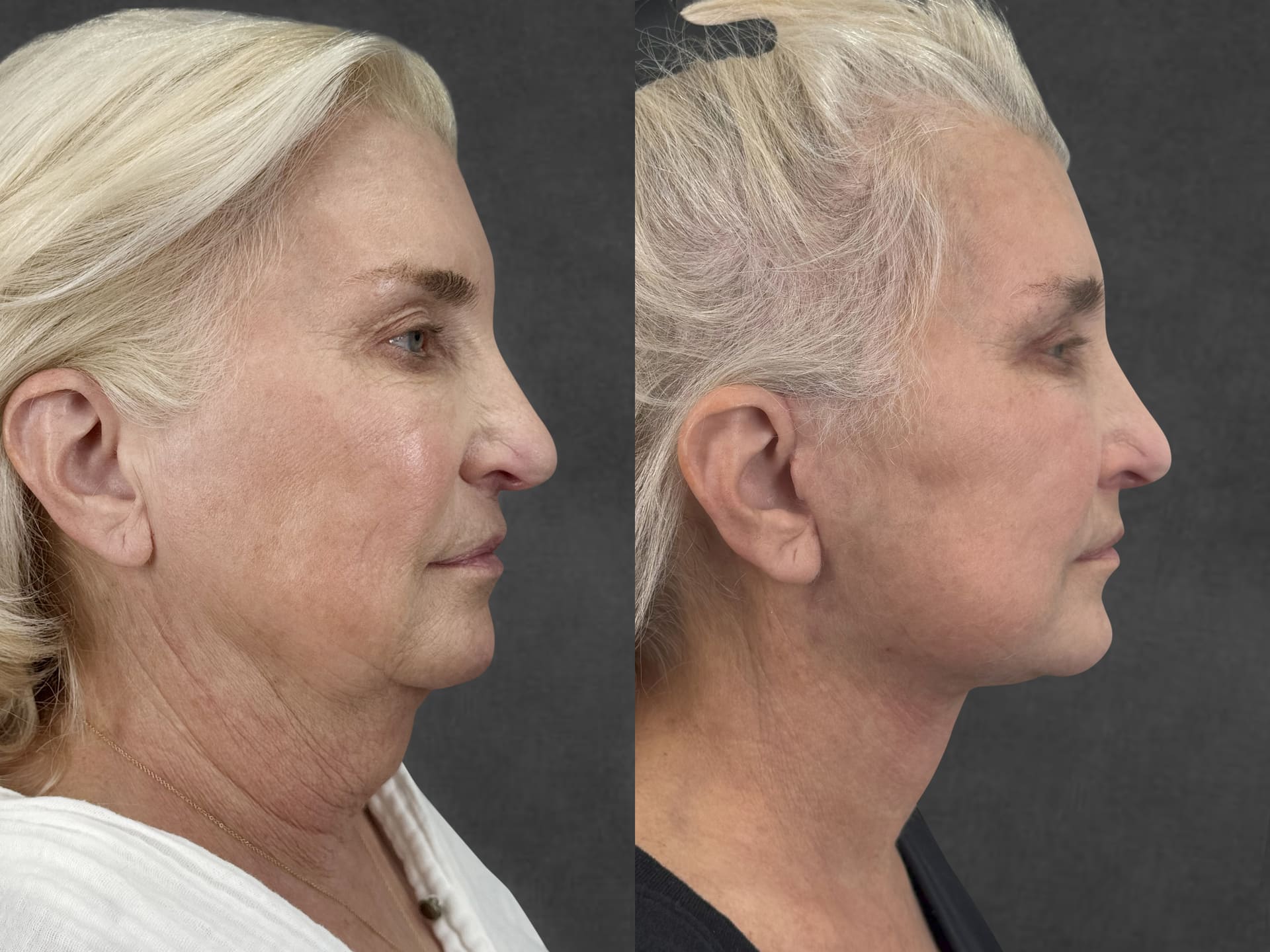 Side-by-side comparison of an older woman before and after a facelift and neck lift performed by Dr. Kameron Rezzadeh, showcasing smoother skin and a more defined jawline in the after image.
