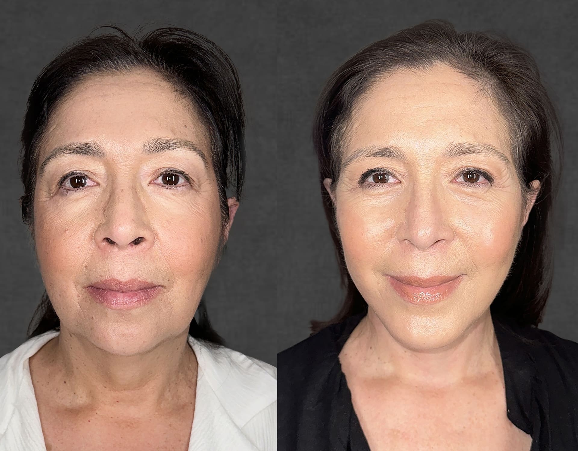 Two side-by-side photos of the same patient – neutral expression on the left, slight smile on the right. Patient after facelift, neck lift, and upper blepharoplasty performed by Dr. Kameron Rezzadeh.