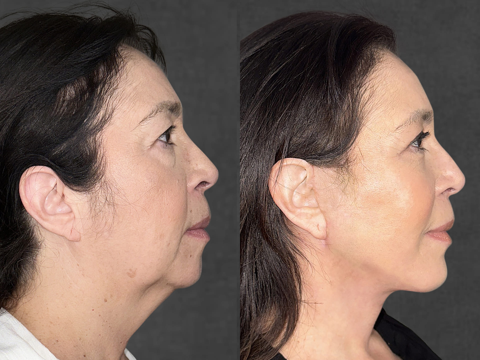 Two side-by-side photos of the same patient – neutral expression on the left, slight smile on the right. Patient after facelift, neck lift, and upper blepharoplasty performed by Dr. Kameron Rezzadeh.