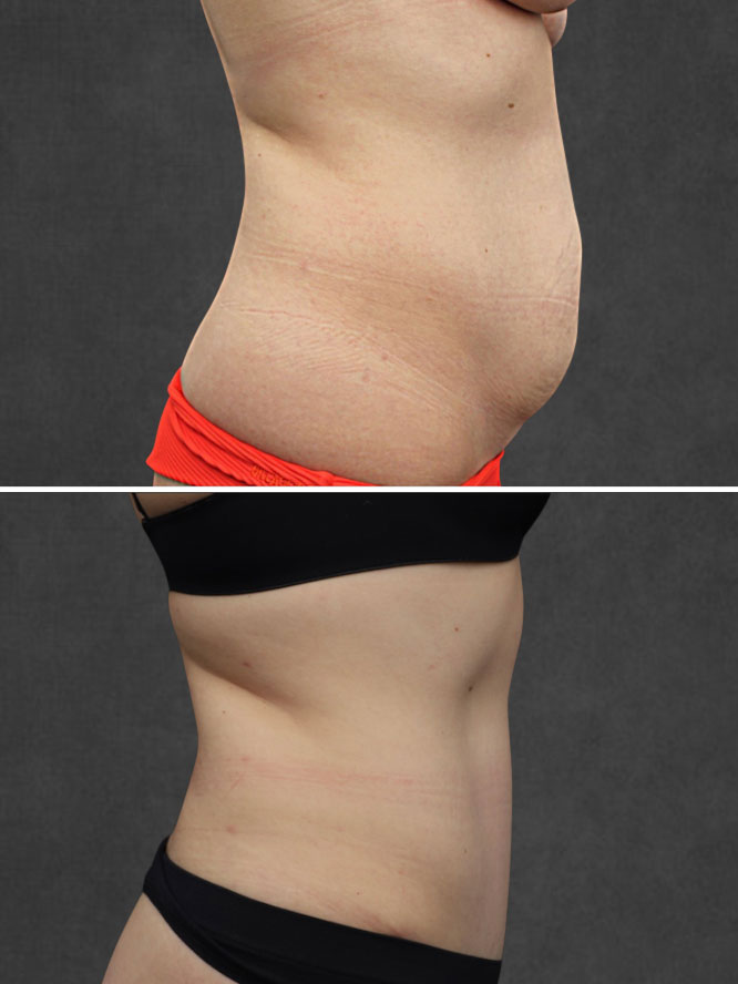Side-by-side comparison of a woman's abdomen before and after body contouring, showing reduced belly size and smoother skin in the after image.