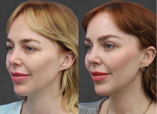 Side-by-side comparison of the same woman showing her profile before and after a facial treatment. Changes include improved skin tone and texture, slightly different hairstyle, and makeup.