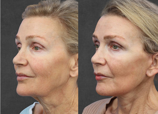 Side-by-side images of a woman before and after a cosmetic procedure, showing reduced wrinkles and tightened skin on her face in the "after" photo.