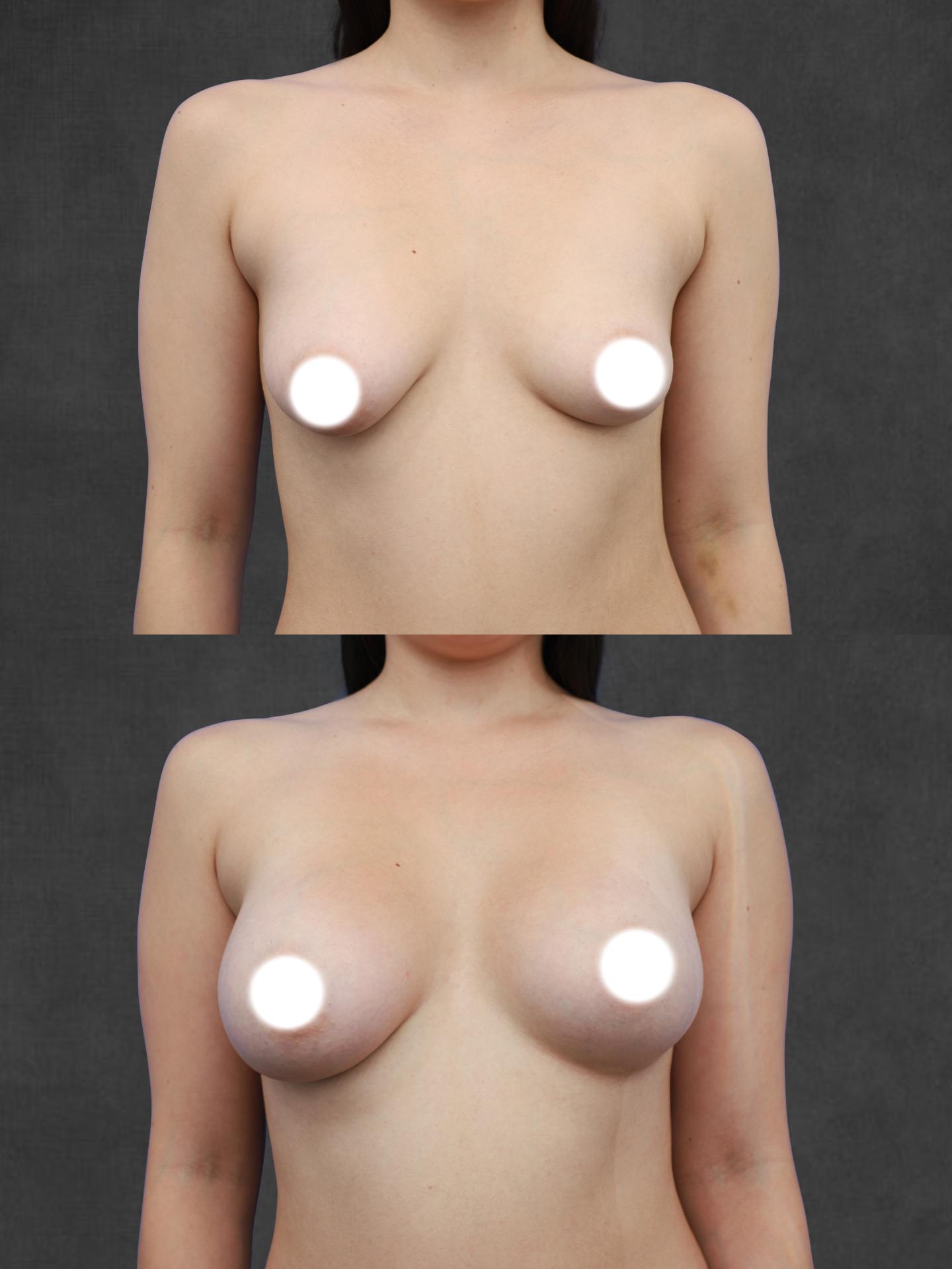 Before and after breast augmentation photos, showing changes in the appearance of the breasts post-surgery. White circles cover the nipples.