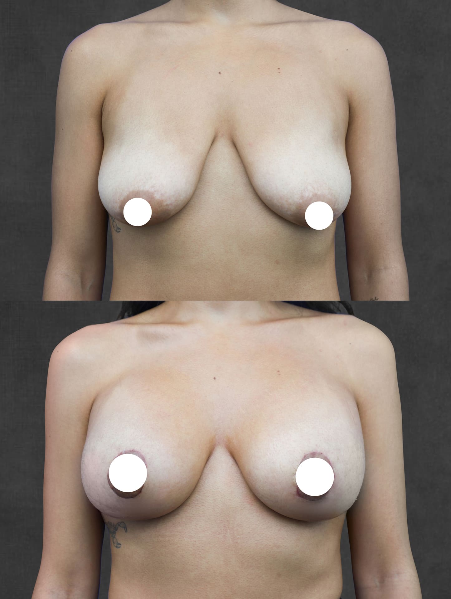 Before and after images of a person showing changes in breast appearance post-surgery, with circular covers over the nipples for modesty.