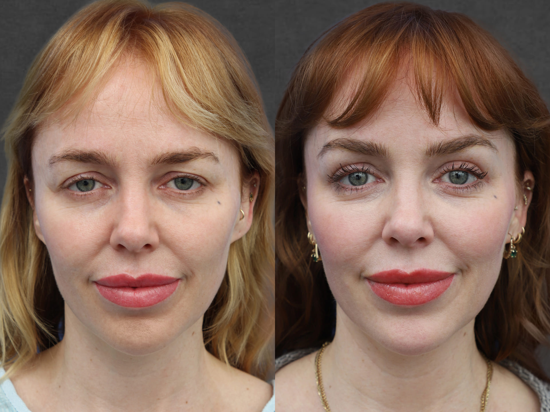 Two side-by-side images of a woman in profile who has undergone a brow lift and upper blepharoplasty. The results of the procedures show a noticeable lift in the brows and smoother eyelid skin, giving her a more youthful and open appearance.
