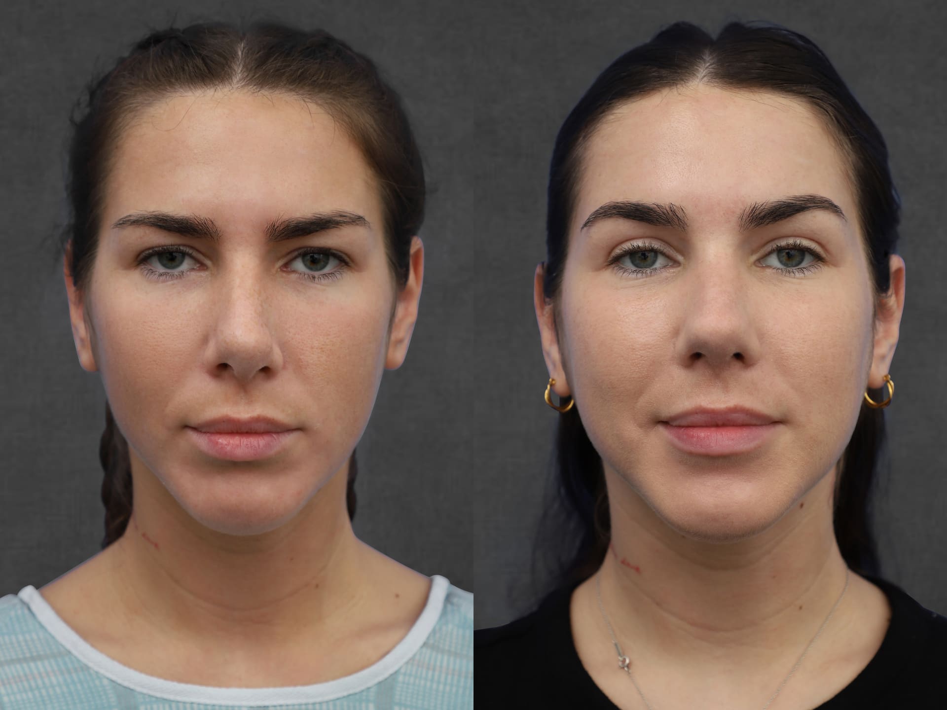 Side-by-side profile images of a woman before and after surgical procedures, showing changes in the brow area and eyelids following a brow lift and upper blepharoplasty. The results of the procedures include a lifted brow position and smoother eyelid skin, giving her a more youthful and refreshed appearance.