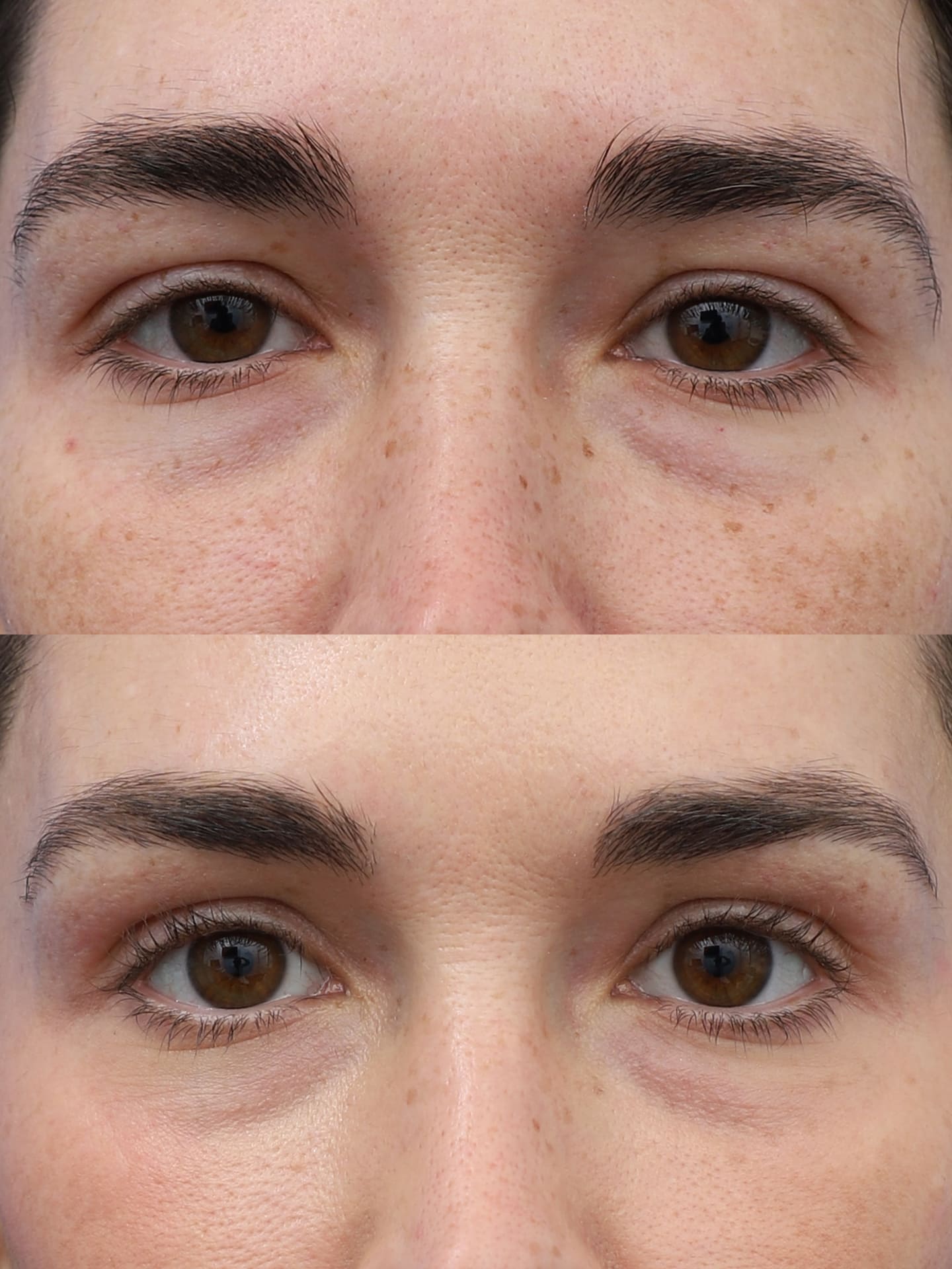 before and after Brow lift