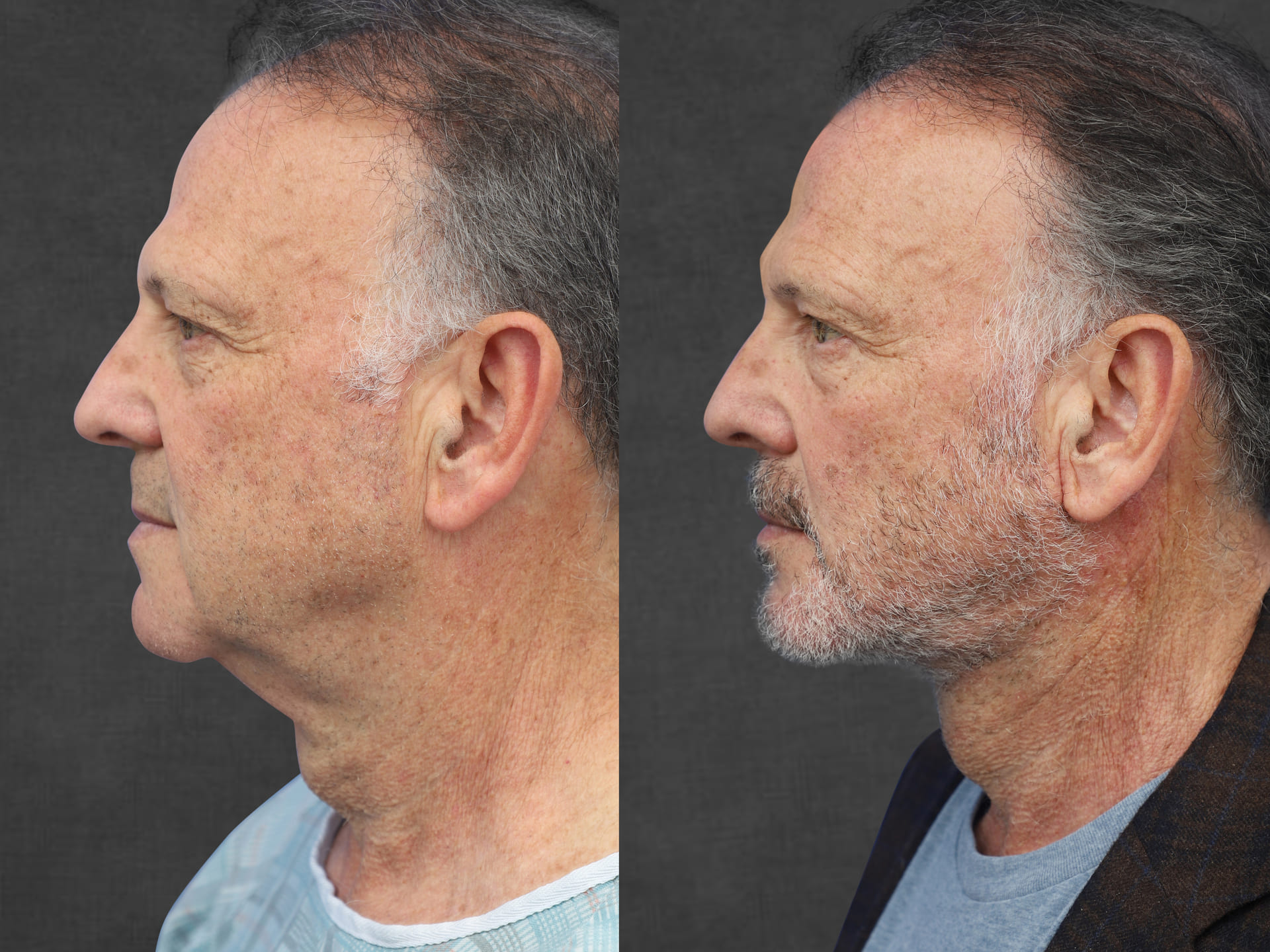Two side-by-side images of a middle-aged man, before and after a neck lift performed by Dr. Kameron Rezzadeh. The left image shows the man before the procedure, and the right image shows the man after the procedure, highlighting the improved appearance of the neck.