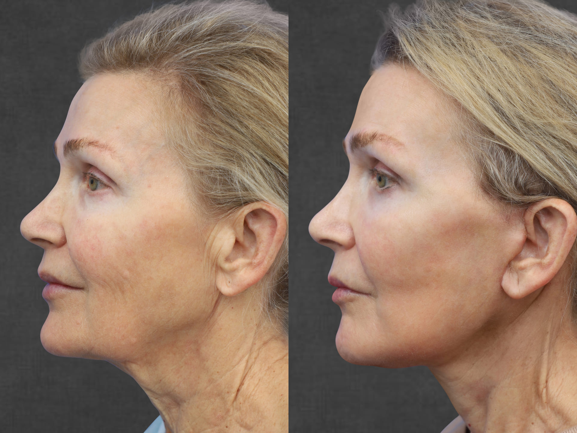 Side-by-side comparison of a middle-aged woman before and after a procedure performed by Dr. Kameron Rezzadeh, showcasing changes in facial skin texture and appearance.