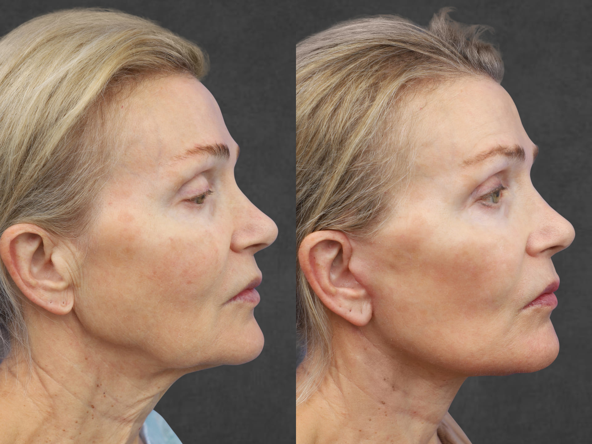 Side-by-side comparison of a middle-aged woman before and after a procedure performed by Dr. Kameron Rezzadeh, showcasing changes in facial skin texture and appearance.