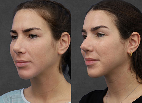 Two side-by-side images of a person before and after a cosmetic procedure, showing changes in facial contours and appearance.