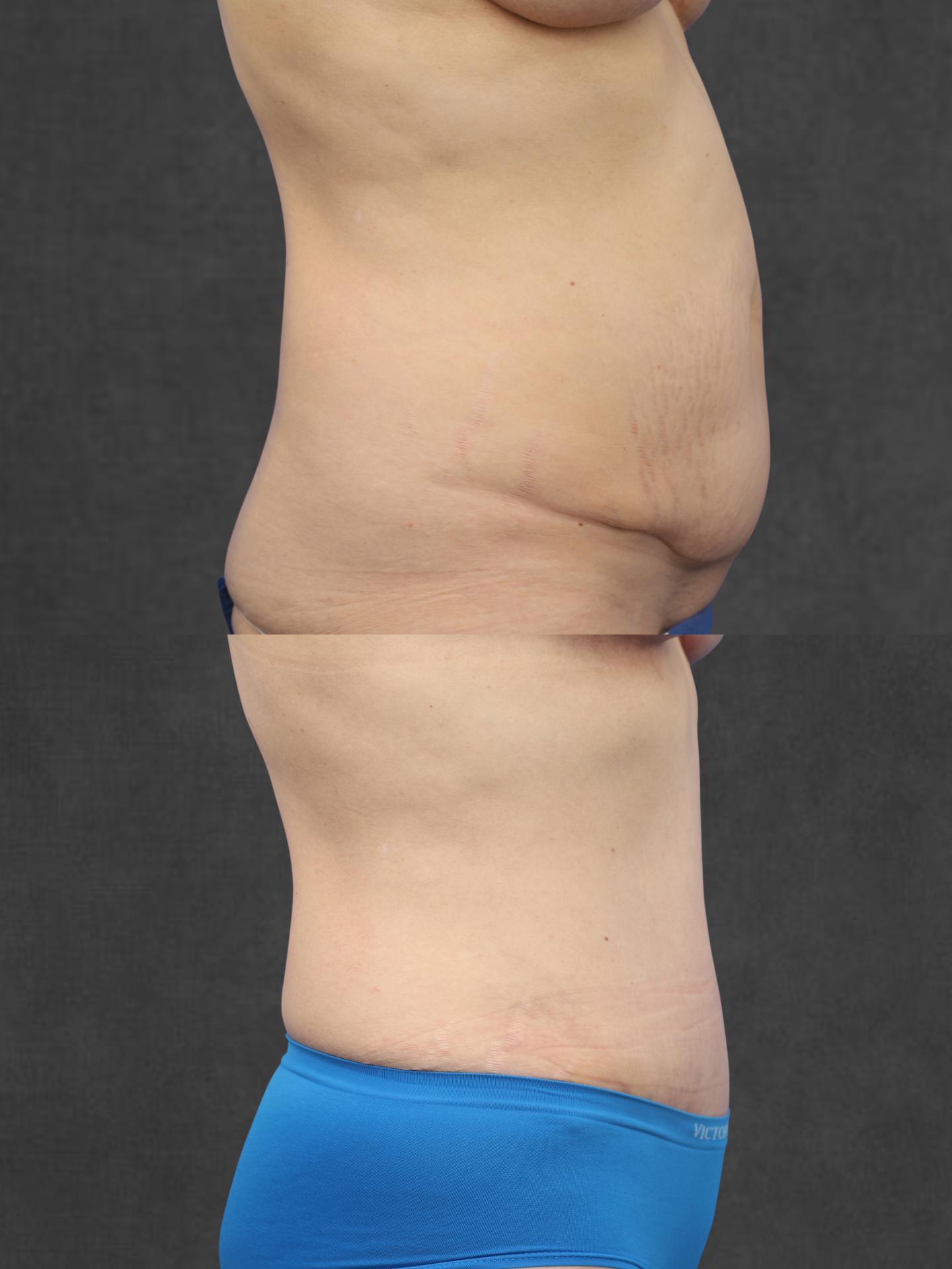 Side-by-side comparison of a person's abdomen before and after a cosmetic procedure, showing reduced abdominal bulge and smoother skin in the after image.
