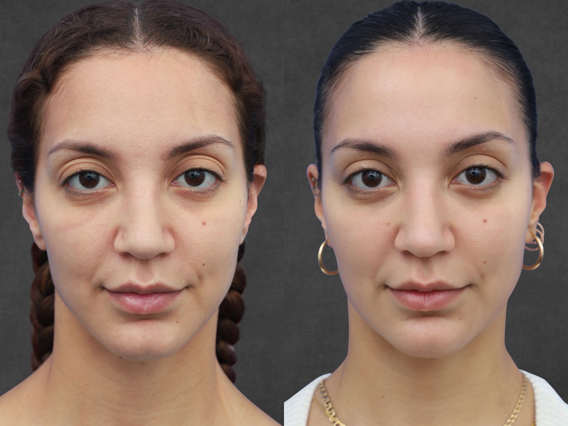 Two side-by-side images showing the right oblique of the same person's face before (right) and after (left) facial fat transfer and upper blepharoplasty. After the procedures, the eyelids appear more defined, and the face looks fuller and more youthful.