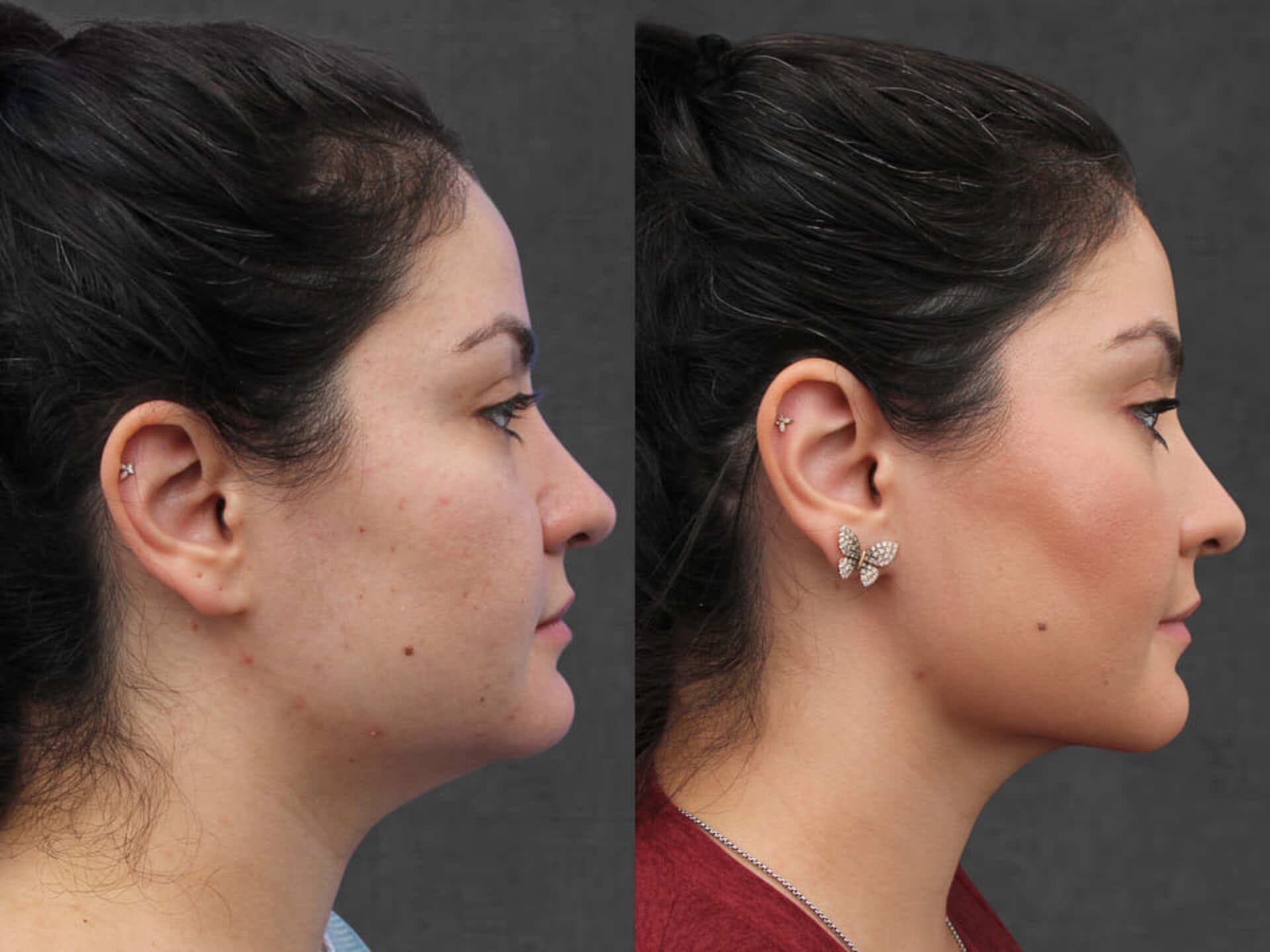 Side-by-side profile images of a woman before and after neck liposuction. The left shows a fuller neck, while the right shows the results of the procedure with a slimmer and more defined neck contour.