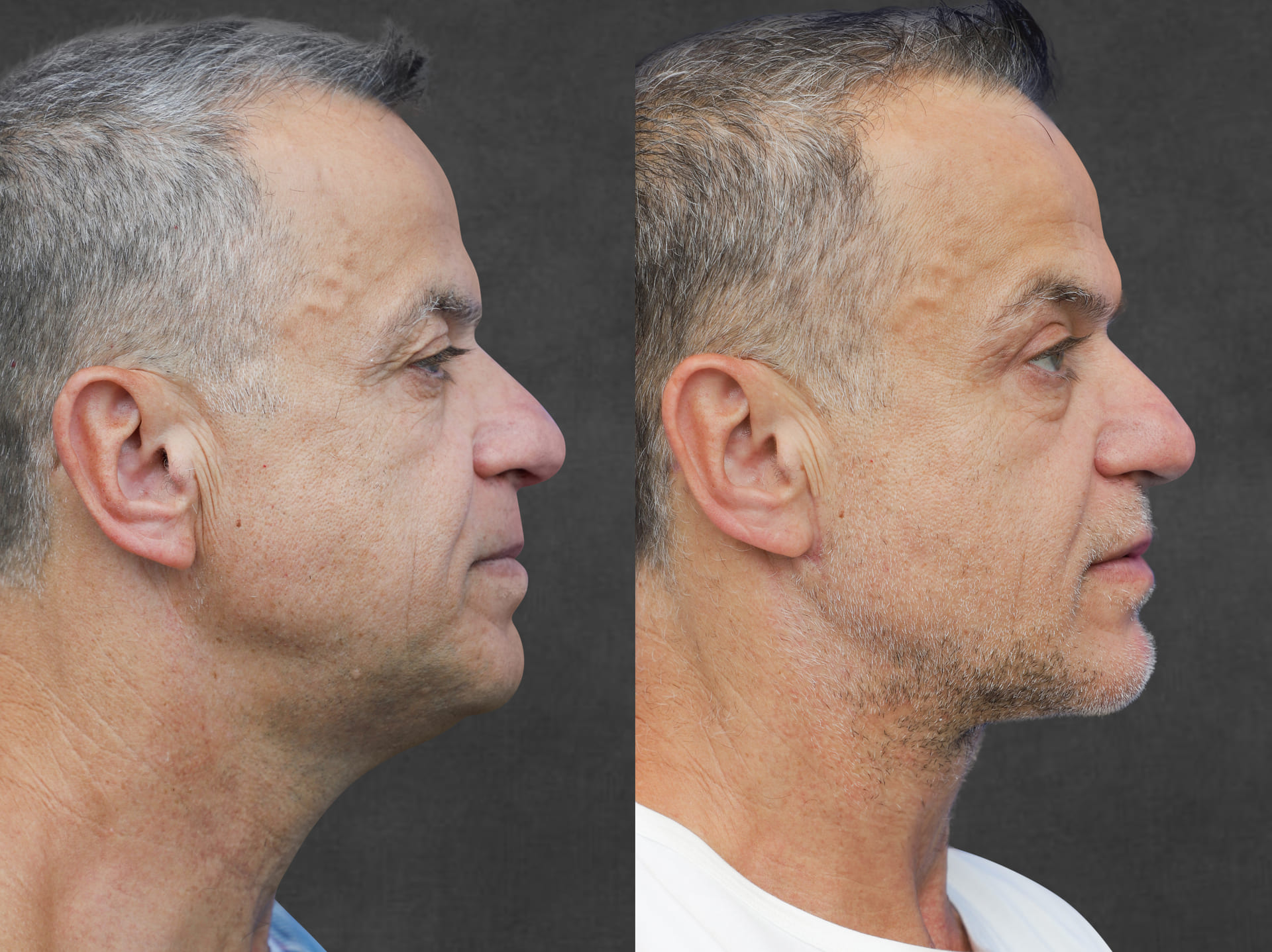 Side-by-side profile images of a man before and after a neck lift, highlighting improvements in jawline contour and smoother neck skin.