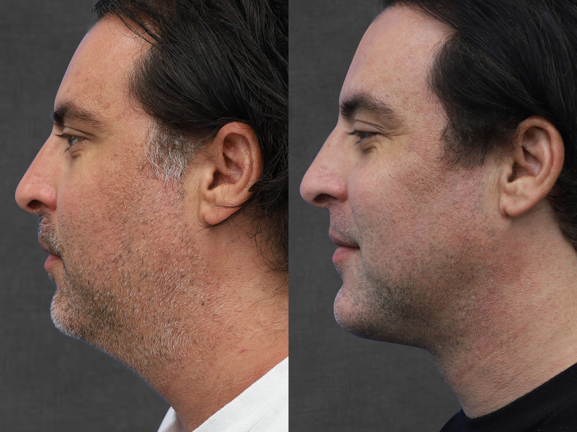 Side-by-side profile images showing a man who has undergone a neck lift. On the left, there is a fuller jawline, while on the right, the effects of the procedure are visible – a more defined jawline and a fuller neck.