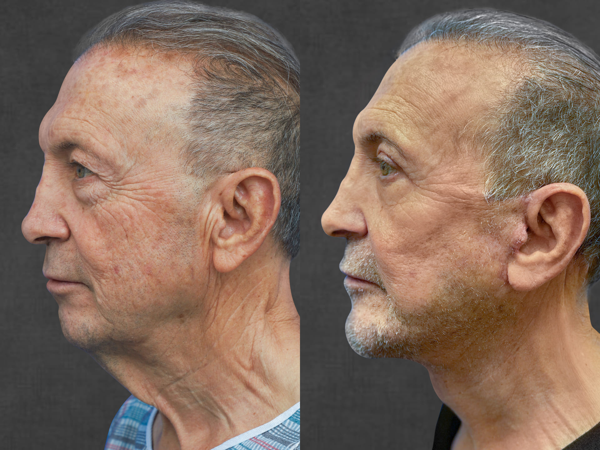 Side-by-side profile images of an older man before and after a cosmetic procedure. The left shows sagging skin, while the right shows a smoother complexion and a more defined jawline.