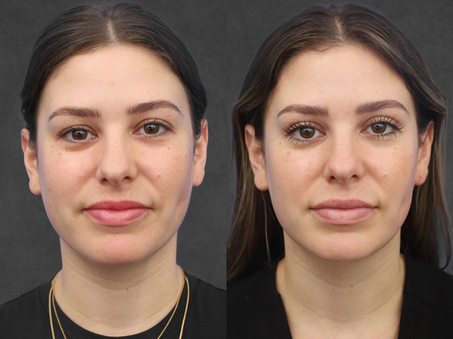 A woman before (left) and after (right) undergoing upper blepharoplasty performed by Dr. Kameron Rezzadeh, showing noticeable improvement in the appearance of the eye area.