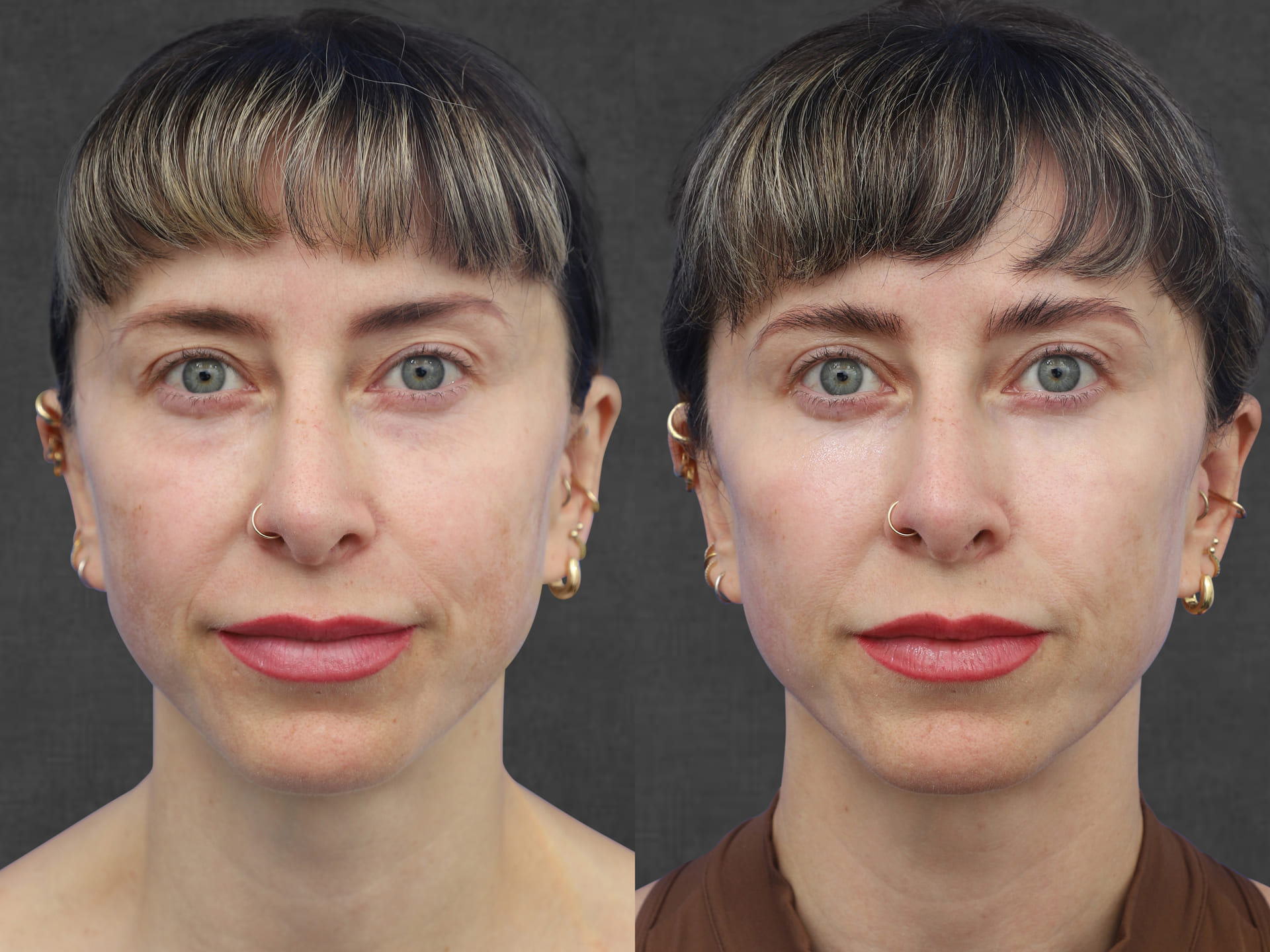 Photo of a woman before and after upper lower blepharoplasty