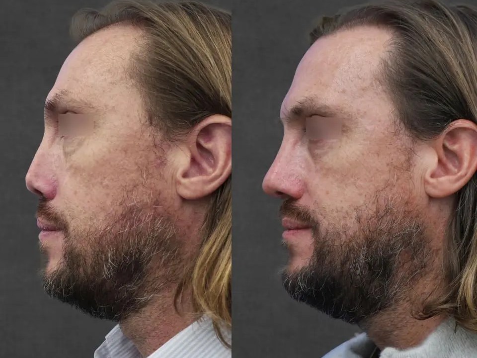 Revision Rhinoplasty