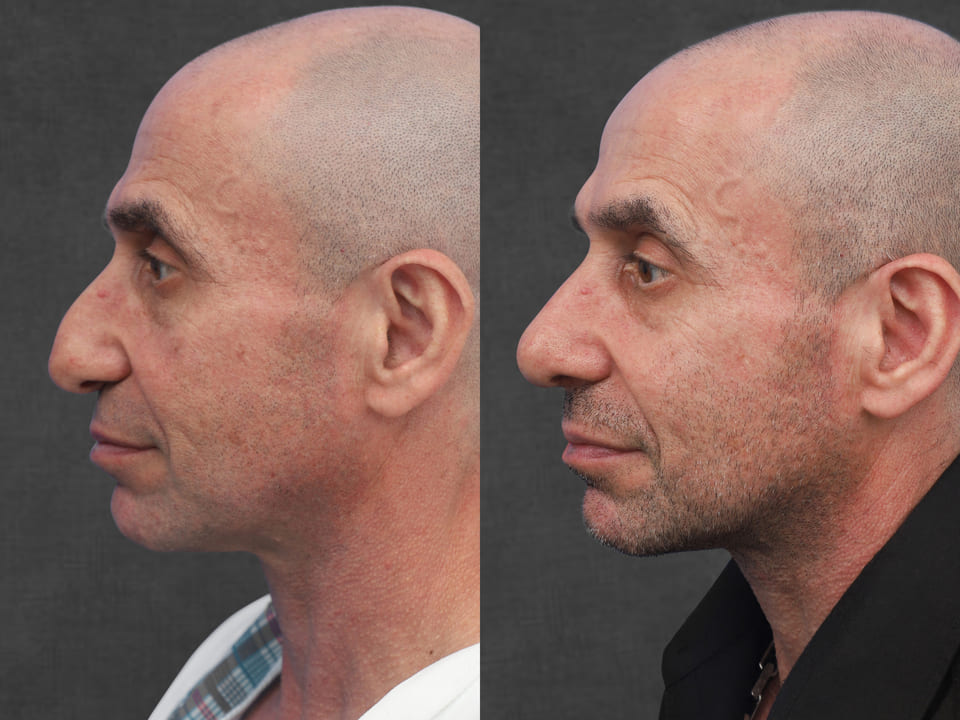 Rhinoplasty