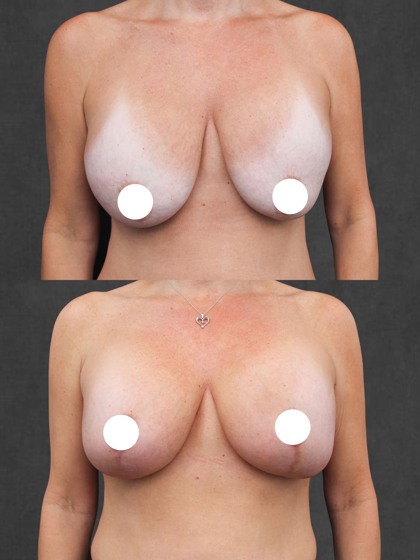 Before and after photos of a woman showing the results of breast implant replacement plus mastopexy; top image is before, bottom image is after the procedure.