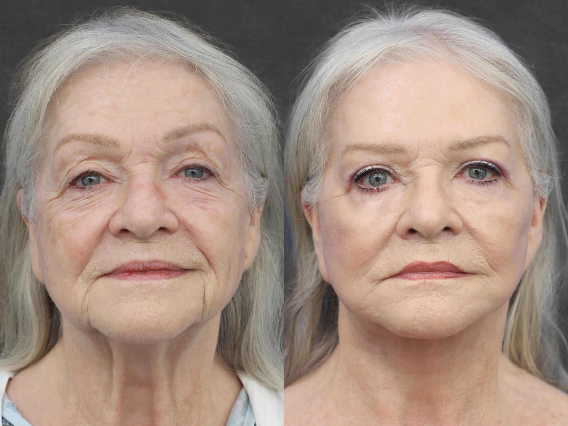 Patient before and after facelift performed by Dr. Kameron Rezzadeh – front view.