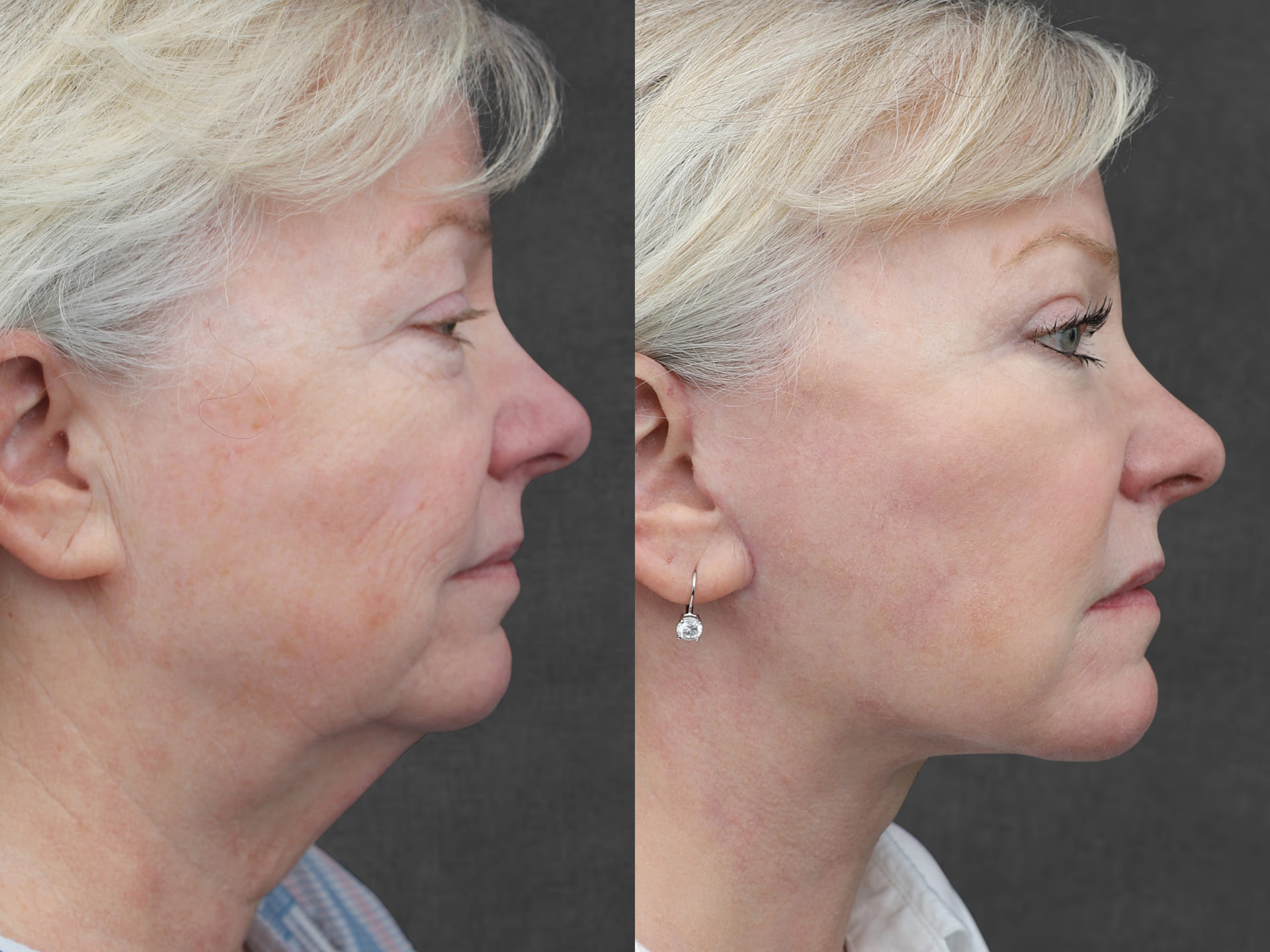 Side-by-side profile photos of the same patient before and after a facelift and neck lift performed by Dr. Kameron Rezzadeh, showing improved skin texture and tightened facial features.