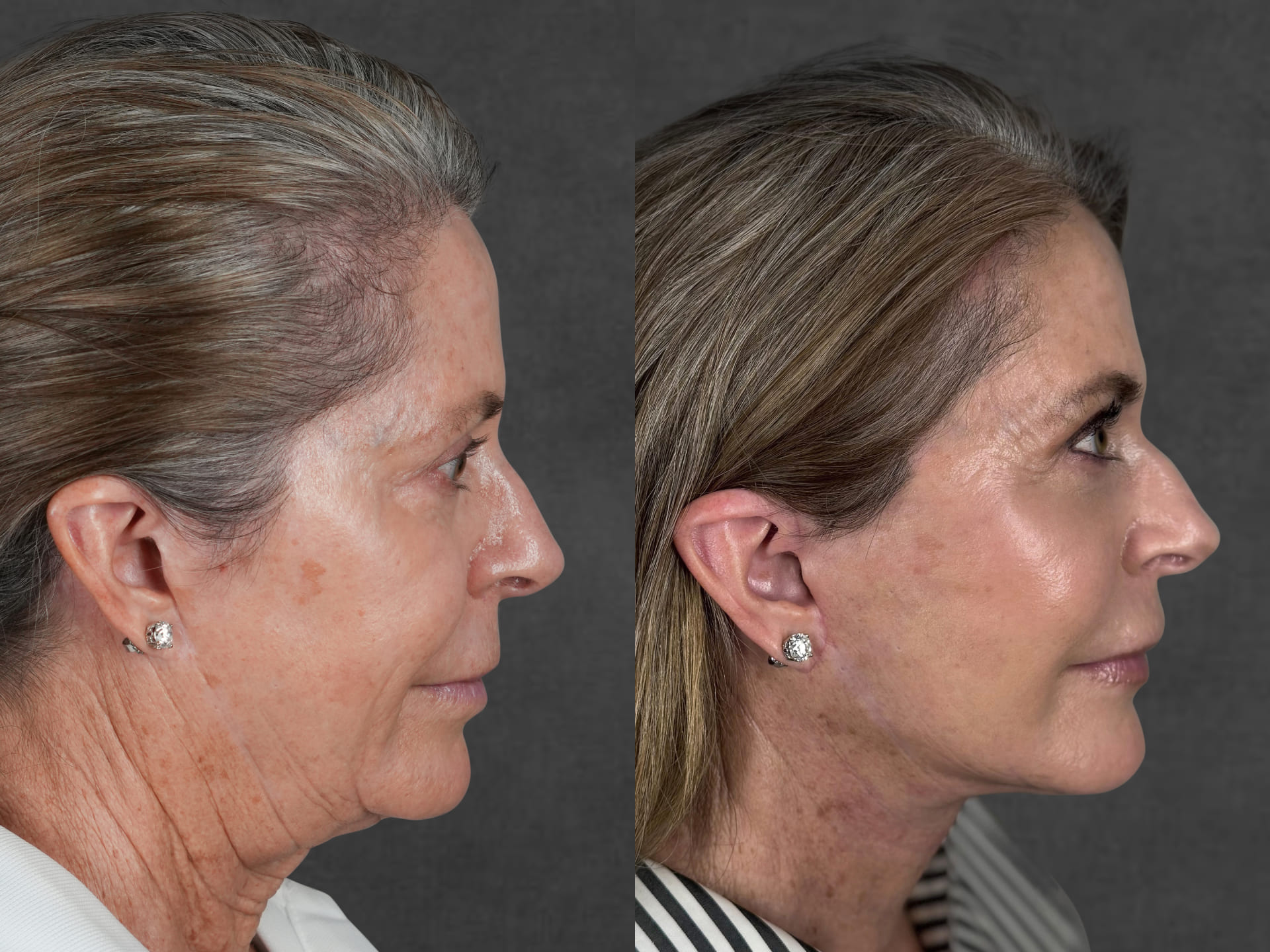 A woman before (left) and after (right) undergoing facelift and neck lift performed by Dr. Kameron Rezzadeh, showing a visible enhancement in the definition of the jawline and neck area.