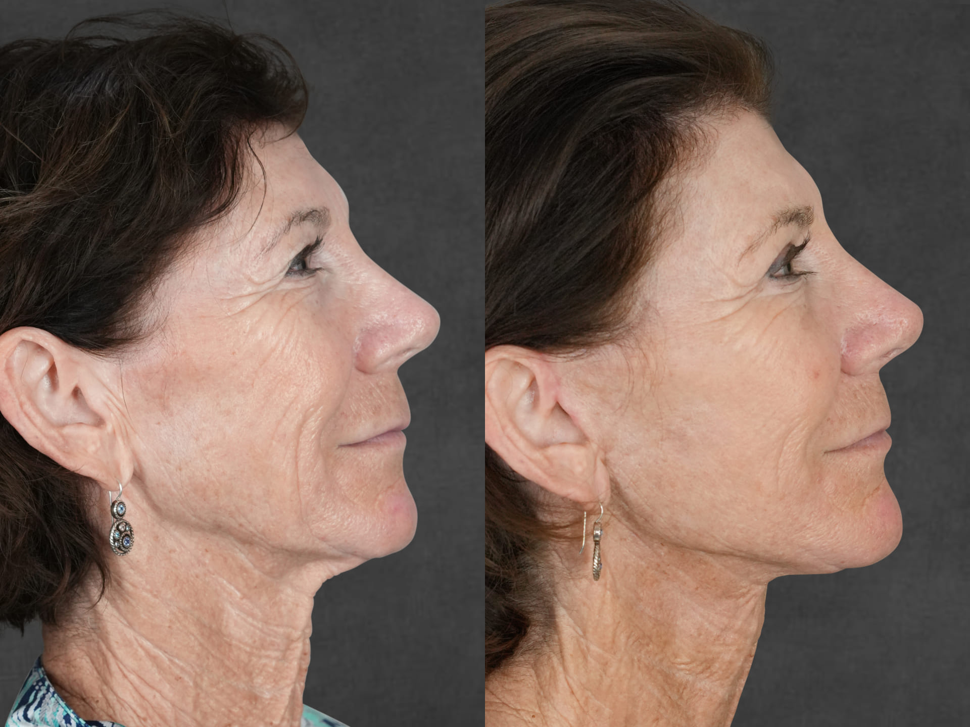 Side-by-side profile photos of a middle-aged woman showing facial skin and neck; left image shows more wrinkles, right image shows smoother skin and fewer wrinkles.