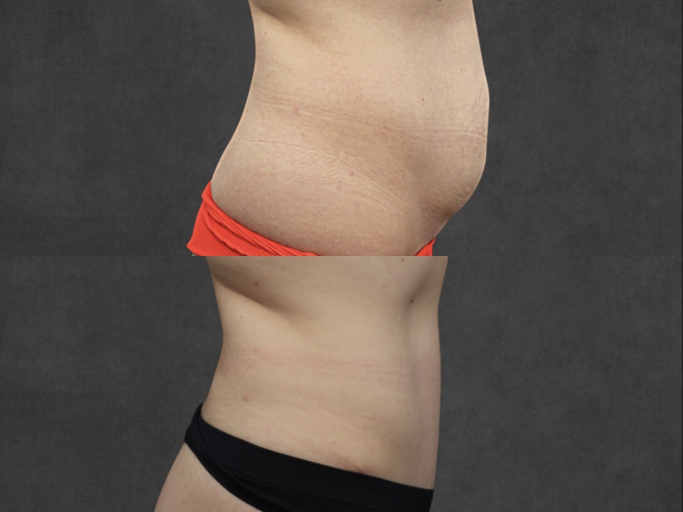 Abdominoplasty