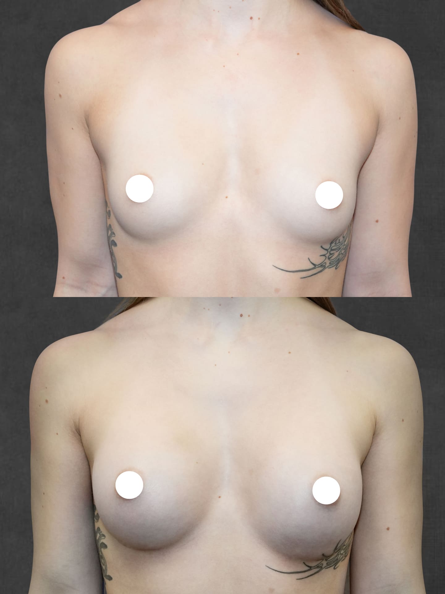 Before and after breast augmentation (front view), showing increased breast size. Nipples covered for privacy.