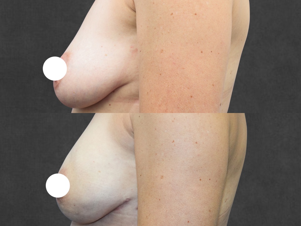 Breast Reconstruction