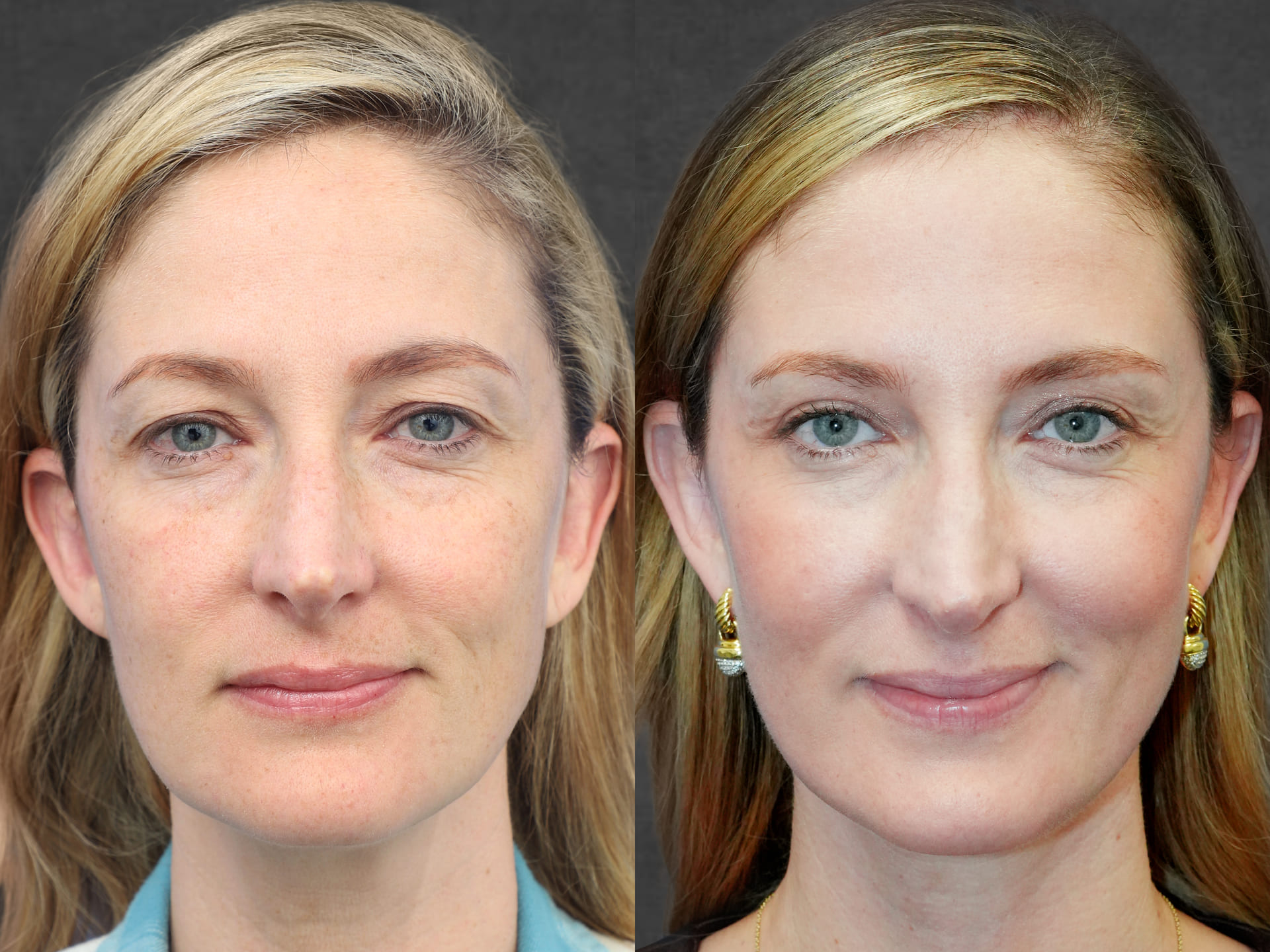 Patient before and after neck lift, upper eyelid surgery, and facial fat transfer by Dr. Rezzadeh – front view.