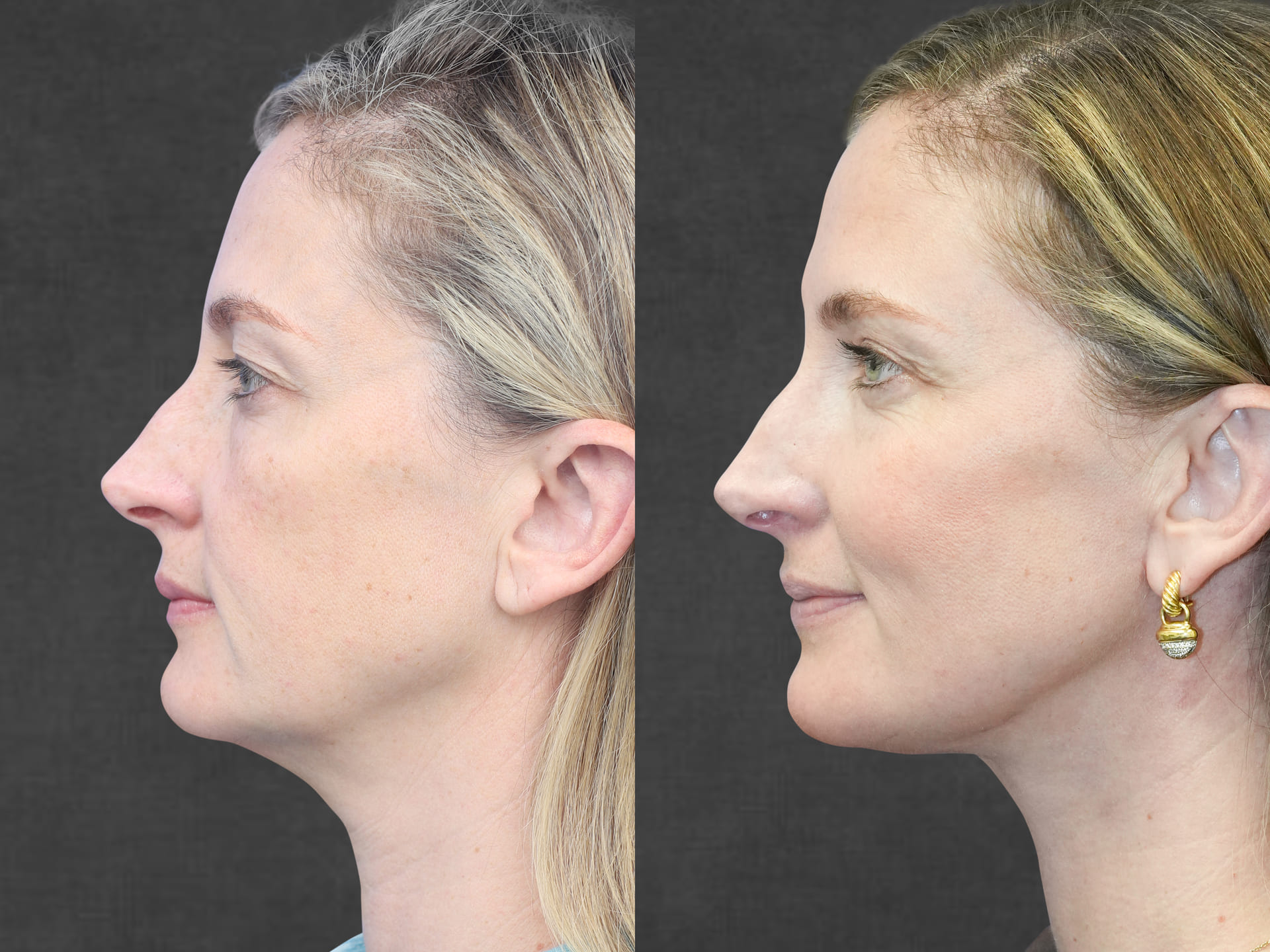 Patient before and after neck lift, upper eyelid surgery, and facial fat transfer by Dr. Rezzadeh – left side view.