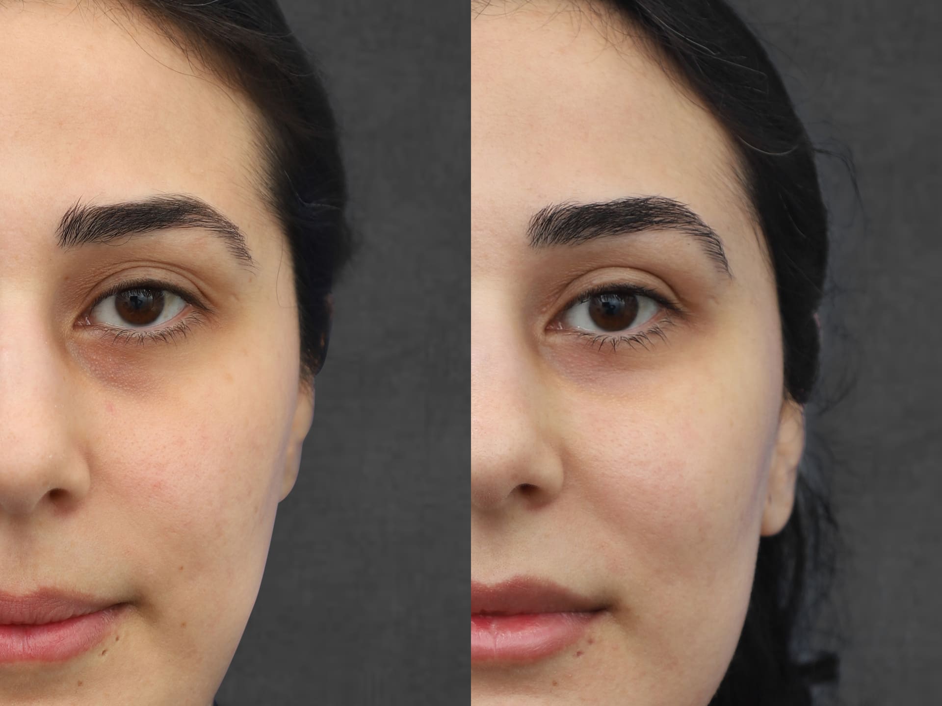 Side-by-side comparison of before and after photos of a female patient who underwent a neck lift, upper blepharoplasty, and facial fat transfer. The images highlight improvements in skin tone, eyebrow shape, and a more youthful appearance of the eyelids.
