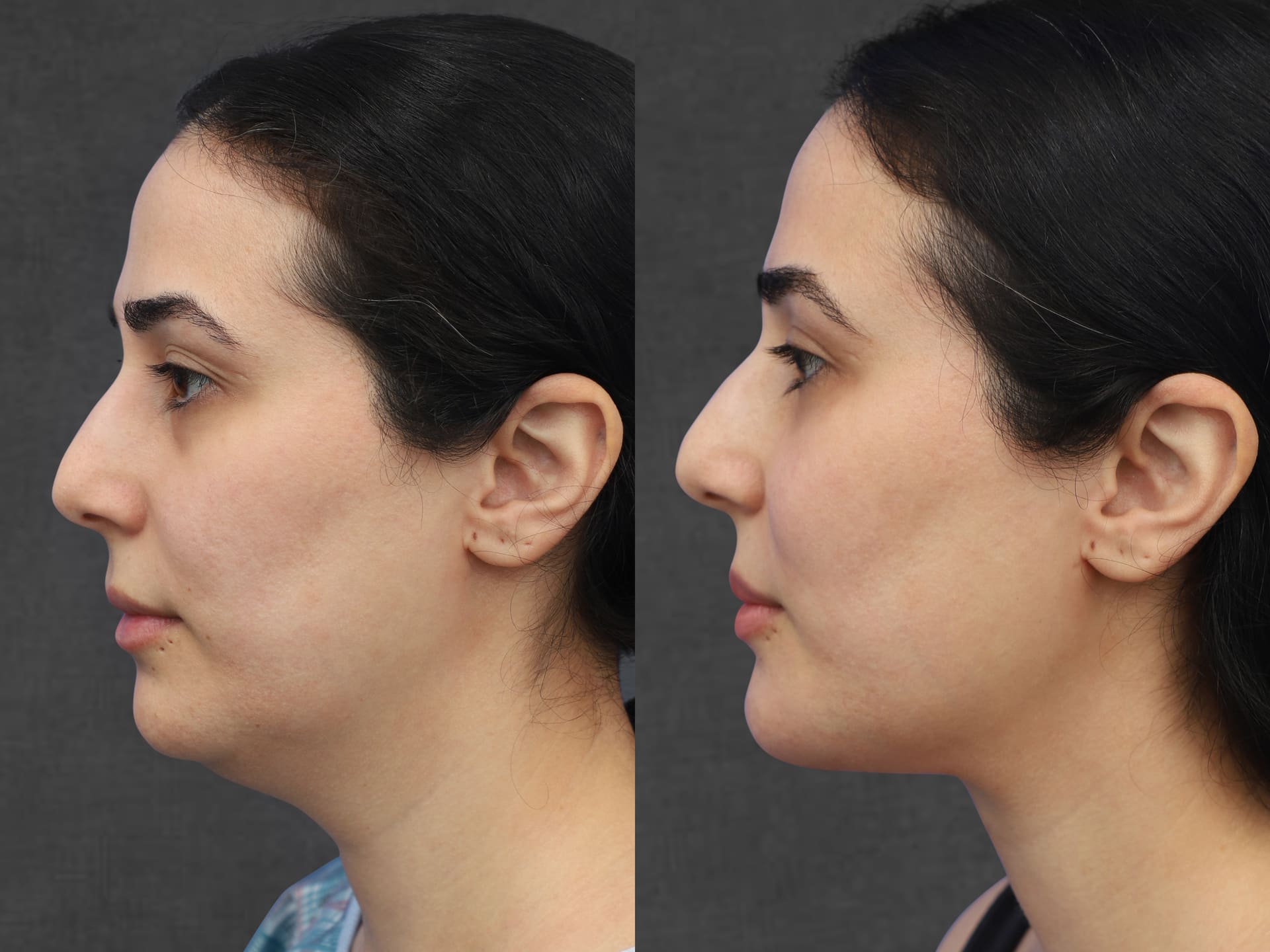Side-by-side comparison of before and after photos of a female patient who underwent a neck lift, upper blepharoplasty, and facial fat transfer. The images highlight improvements in skin tone, eyebrow shape, and a more youthful appearance of the eyelids.