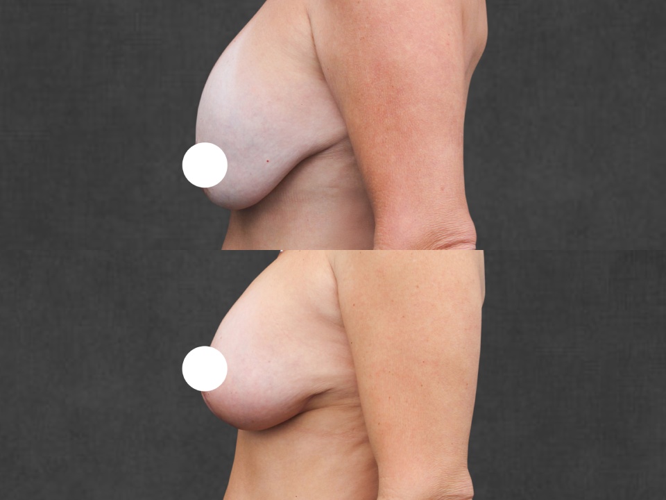 Breast Implant Removal & Exchange