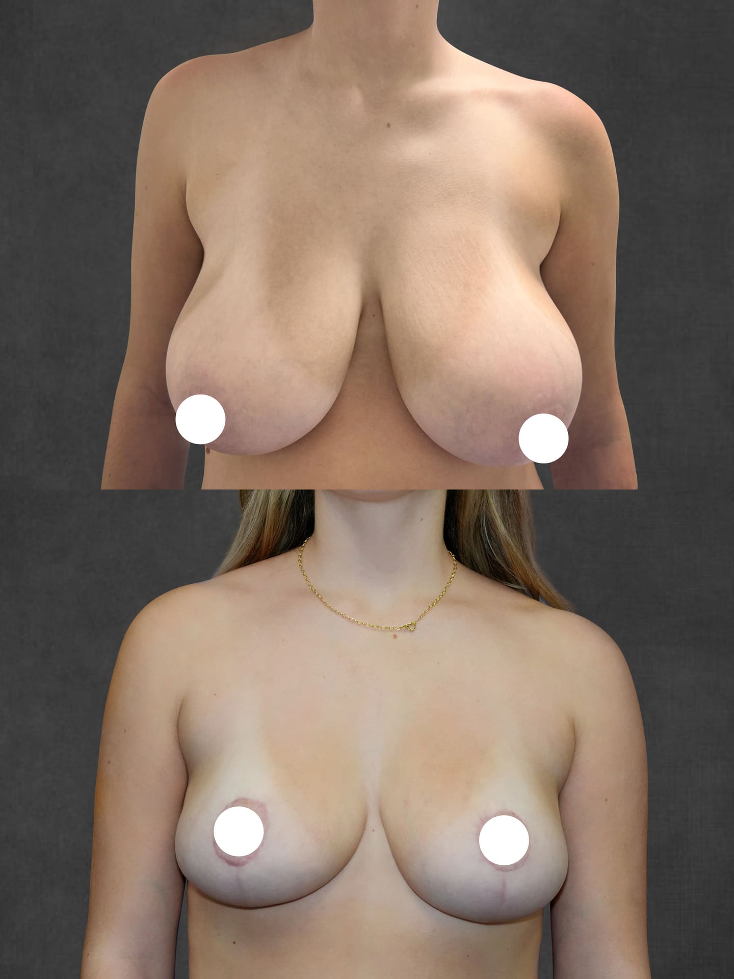 Two side-by-side images show a woman's torso before and after breast reduction surgery, with nipples censored by white circles.