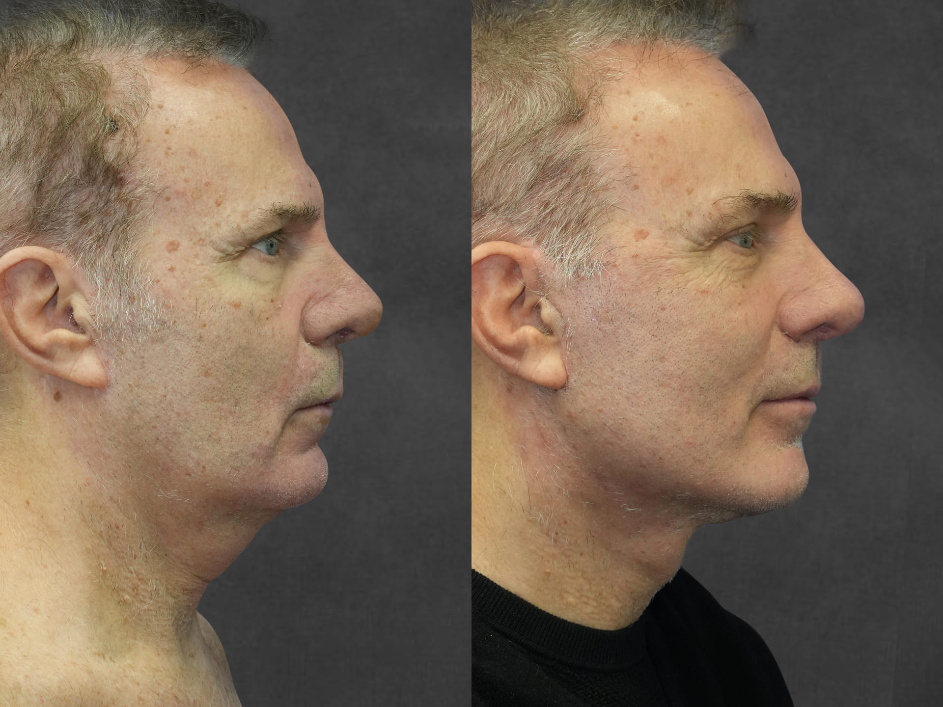 Before and after results of facelift, neck lift and lip lift – right view by Dr. Kameron Rezzadeh