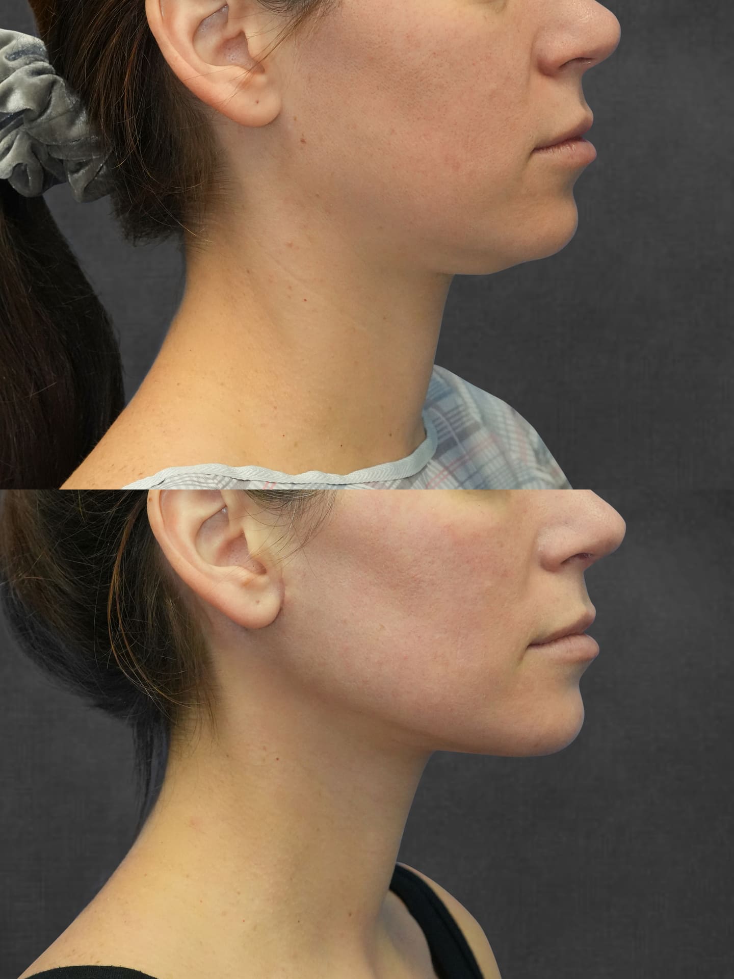 Before and after results of necklift – right side view by Dr. Kameron Rezzadeh