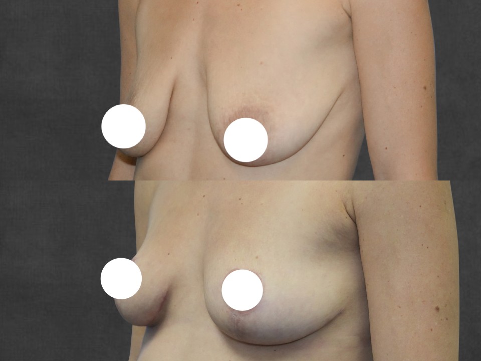 Breast Lift & Reduction