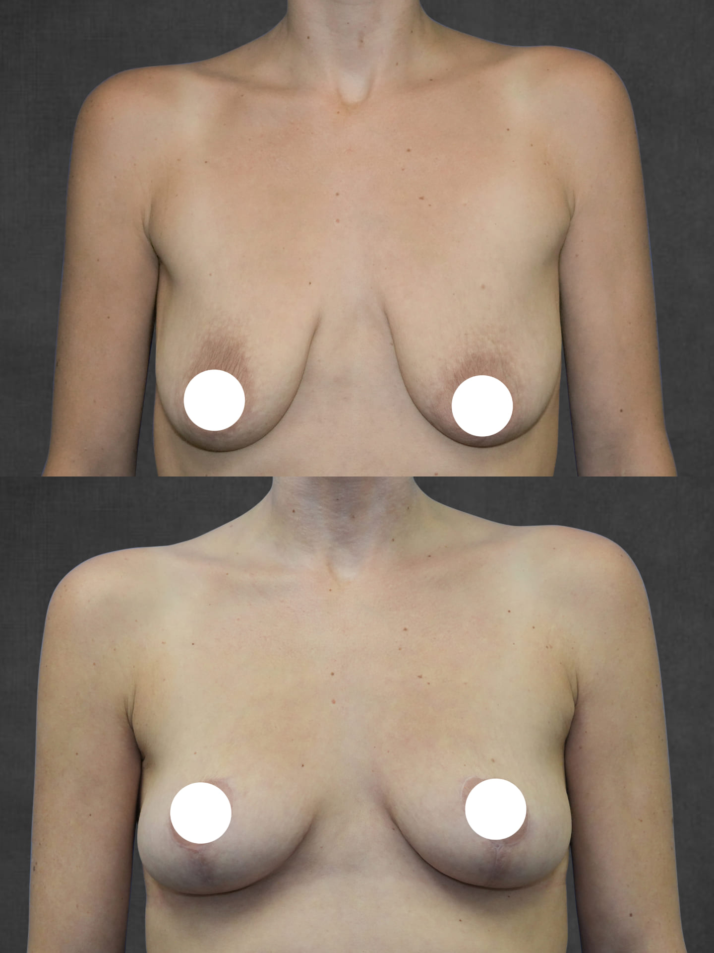 Before and after results of mastopexy – front view by Dr. Kameron Rezzadeh