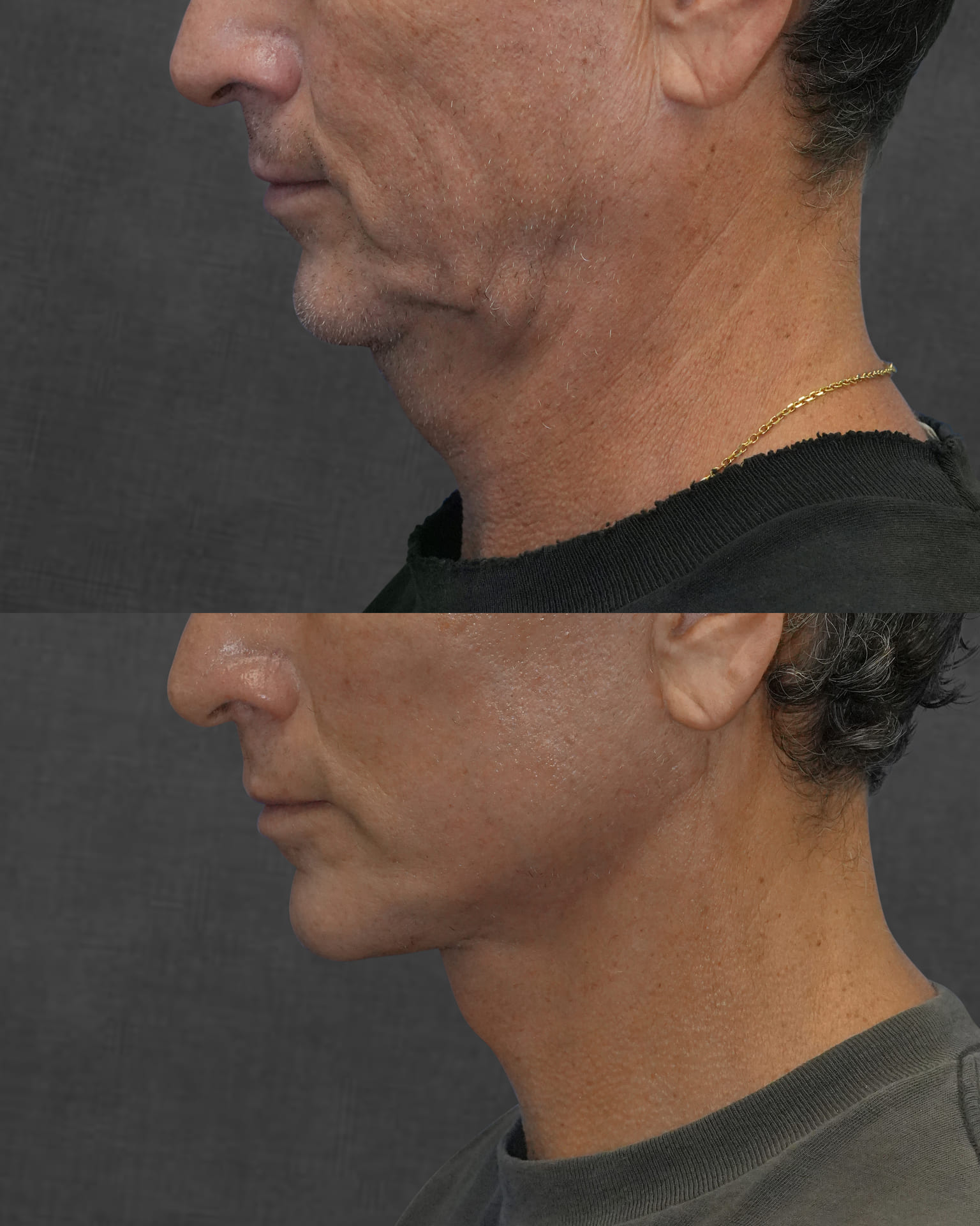 Side-by-side comparison of a man's lower face and neck before and after a cosmetic procedure, showing reduced sagging and a more defined jawline in the after image.
