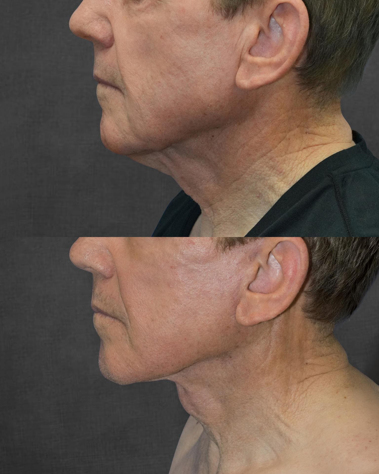 Side-by-side comparison of a man’s lower face and neck before (top) and after (bottom) a cosmetic procedure, showing reduced sagging and smoother skin in the after image.
